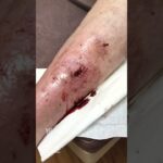 epidural hematoma full video