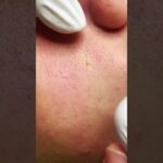 blackhead removal videos