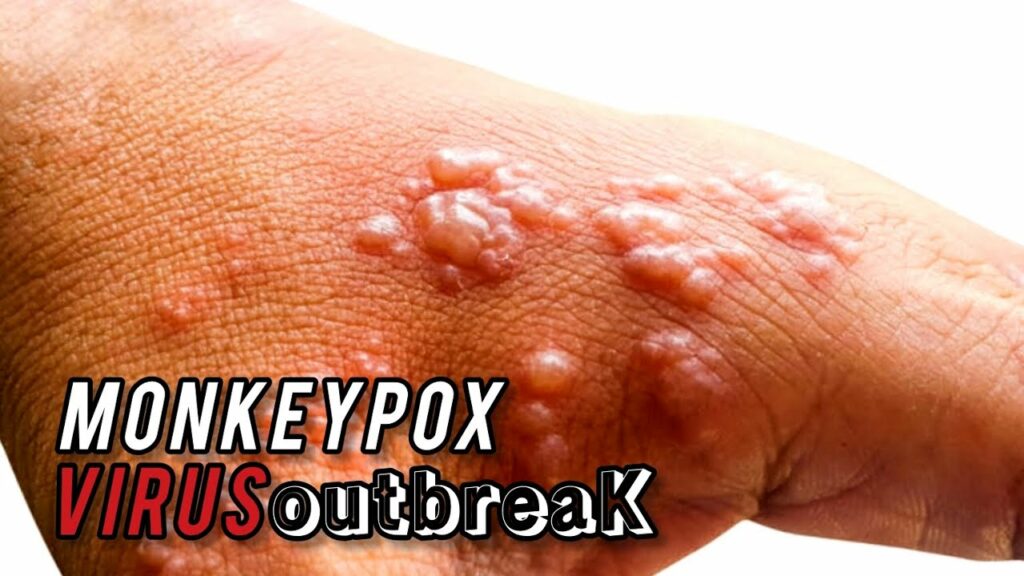 mpox virus outbreak