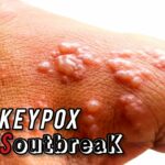 mpox virus outbreak