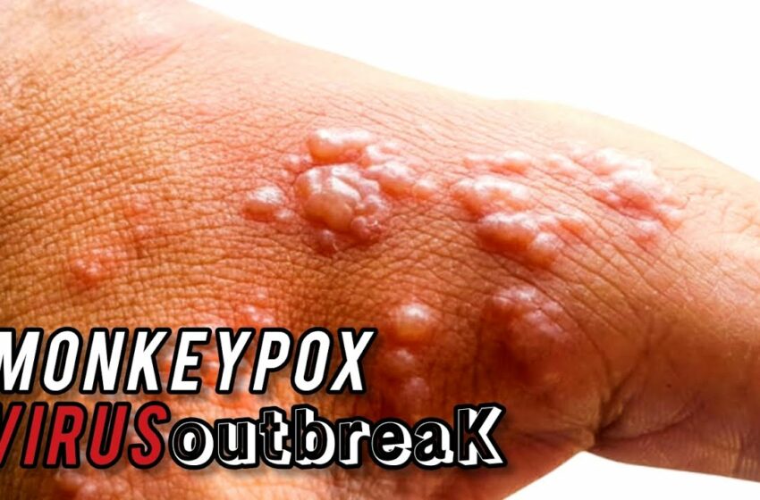  mpox virus outbreak